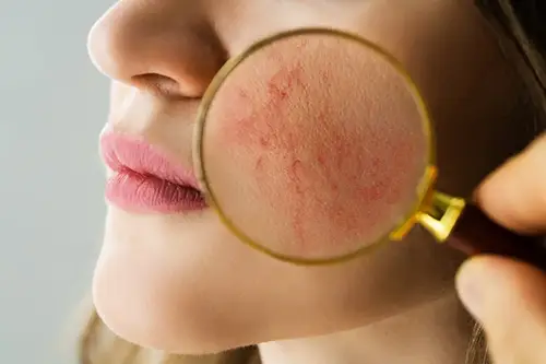 rosacea sintomas